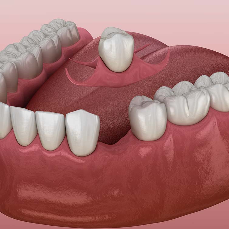 Treatment - Huntingdon Smiles