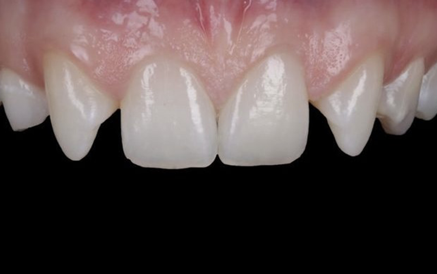 Before - Huntingdonsmile