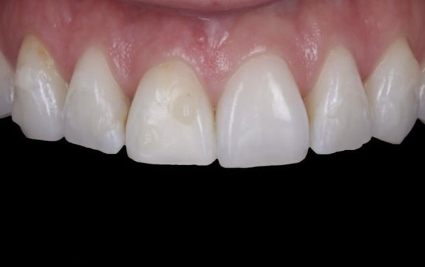 Before - Huntingdonsmile