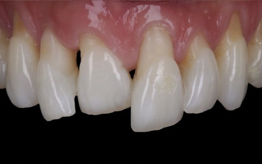 Before - Huntingdonsmile