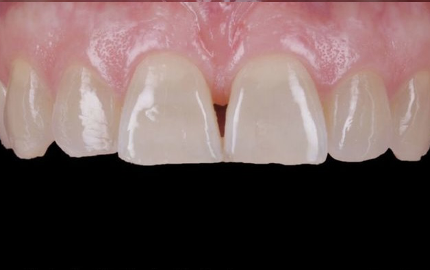 Before - Huntingdonsmile