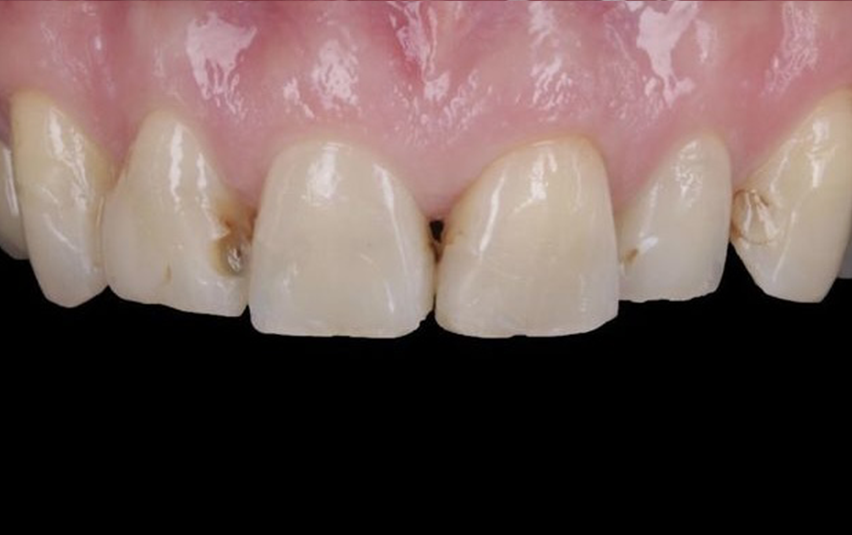 Before - Huntingdonsmile
