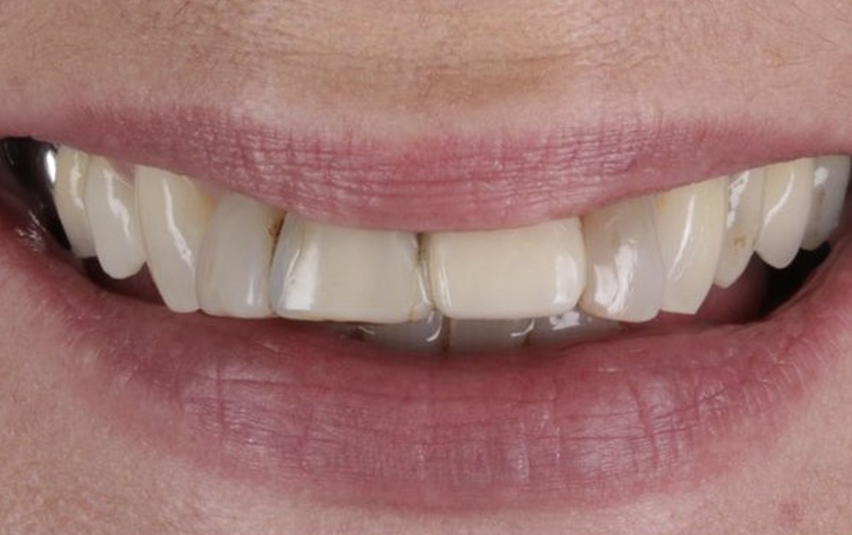 Before - Huntingdonsmile