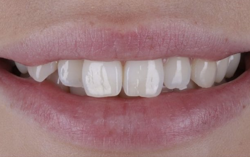 Before - Huntingdonsmile