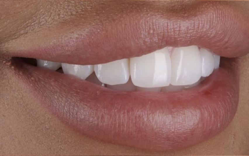After - Huntingdon Smiles